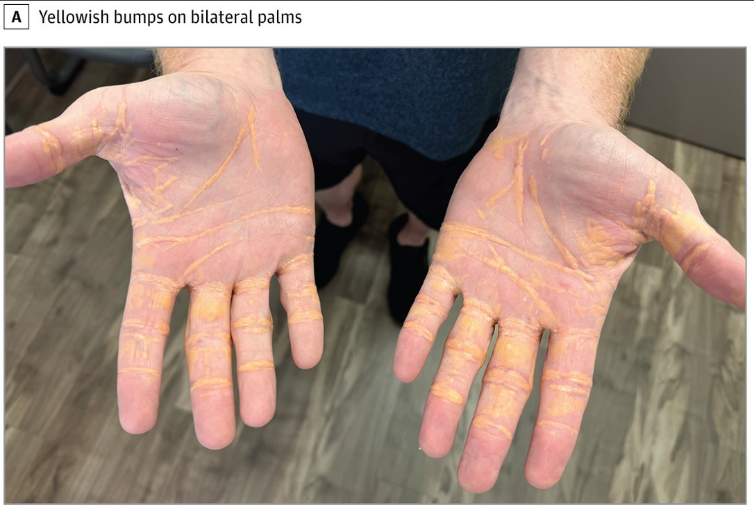 Painless yellowish nodules were observed on the patient’s palms (A) and elbows. B, Magnified view of the palmar lesions. These lesions are consistent with xanthelasma, likely resulting from severe hypercholesterolemia associated with a high-fat carnivore diet